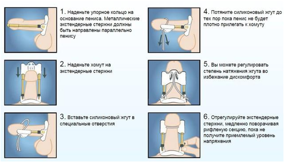 как с помощью экстендера увеличить половой член