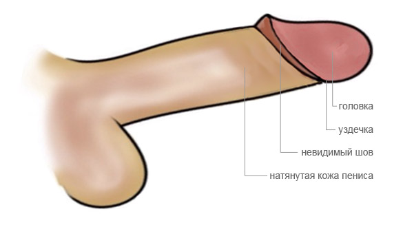 Cхема обрезания: пенис после обычного обрезания крайней плоти